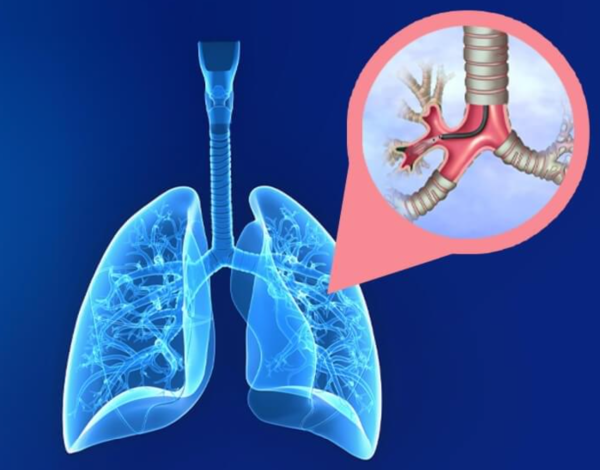 BRONKOSKOPİ ( EBUS, VALV, COIL, BALON, STENT)